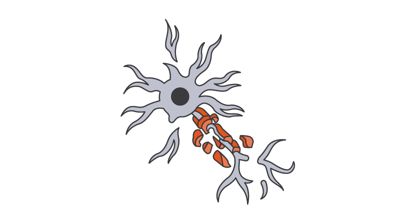 Illustration montrant la perte synaptique induite par la microglie