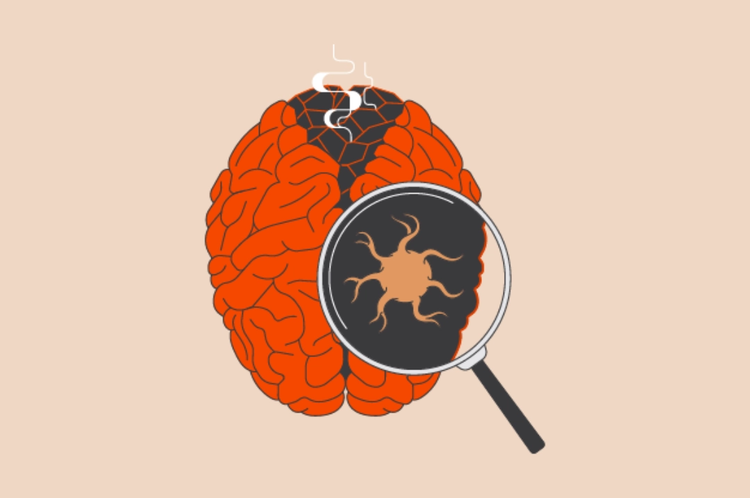 Illustration of a smoldering brain and a magnifying glass showing microglia in the brain